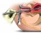 Cum se reface endometrul după chiuretaj Supozitoare după chiuretajul uterului