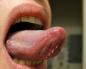 Hvorfor vises utvekster under tungen og hva betyr de?