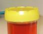 Why does urine turn dark brown and what to do about it? Brownish yellow urine