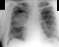 Pleurisy of the lungs: what is it, how to treat folk remedies?