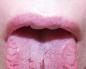 Zapalenie języka, jak leczyć w domu