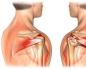 Entorsa piciorului: simptome și tratament Ce trebuie să faceți dacă vă întorsați un tendon