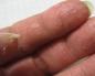 Nail problems: cracks and delamination