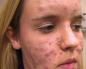 The influence of nutrition on the appearance of acne Nutrition for acne on the face and back