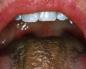 Flekker på tungen: årsaker og typer En svart prikk vises på tungen