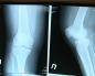 الأشعة السينية لمفصل الركبة: ما يظهره التشخيص الأشعة السينية العادية لمفصل الركبة